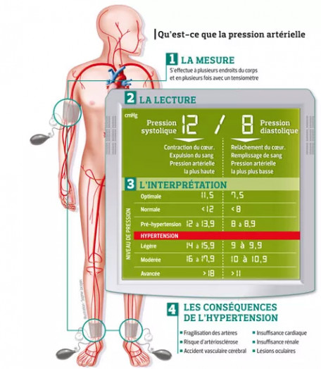 Hypertension artérielle Synonyme : HTA