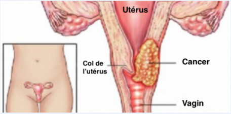 Cancer du col de l’utérus