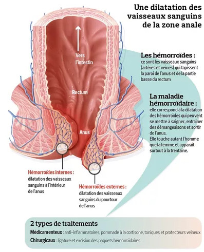 Hémorroides : reconnaître les hemorroides internes ou externes